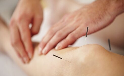 Waarom acupunctuur